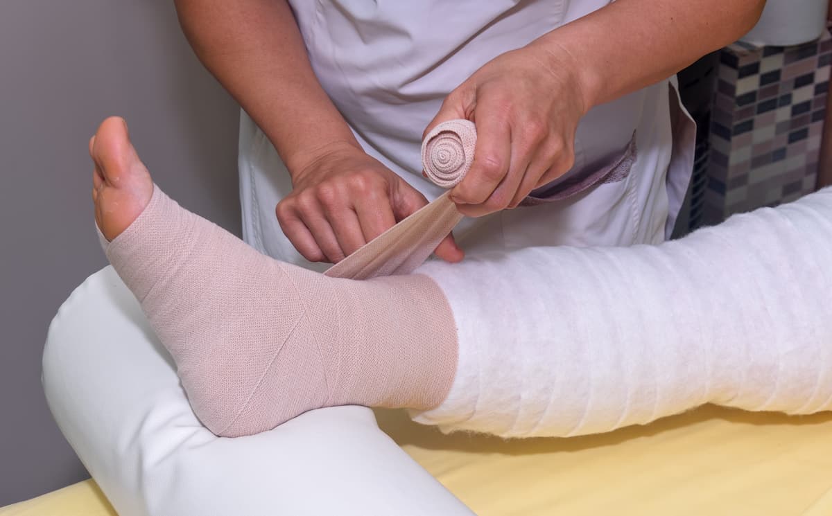 ¿Cómo afecta el linfedema en las piernas?